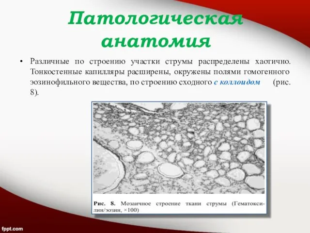 Патологическая анатомия Различные по строению участки струмы распределены хаотично. Тонкостенные капилляры расширены,