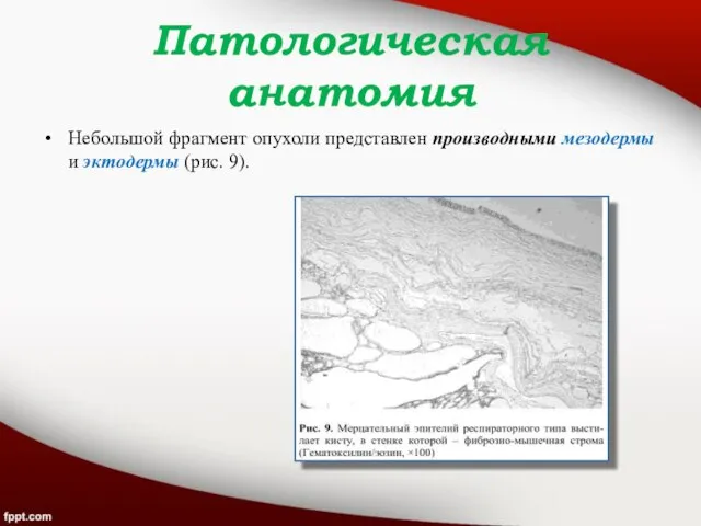 Патологическая анатомия Небольшой фрагмент опухоли представлен производными мезодермы и эктодермы (рис. 9).