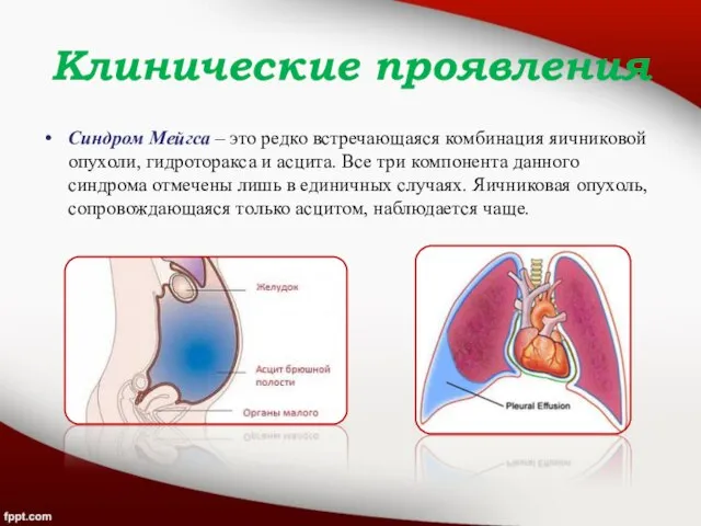 Клинические проявления Синдром Мейгса – это редко встречающаяся комбинация яичниковой опухоли, гидроторакса