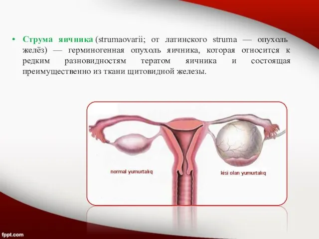 Струма яичника (strumaovarii; от латинского struma — опухоль желёз) — герминогенная опухоль