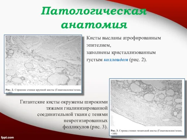 Патологическая анатомия Кисты высланы атрофированным эпителием, заполнены кристаллизованным густым коллоидом (рис. 2).