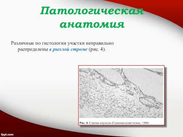 Патологическая анатомия Различные по гистологии участки неправильно распределены в рыхлой строме (рис. 4).