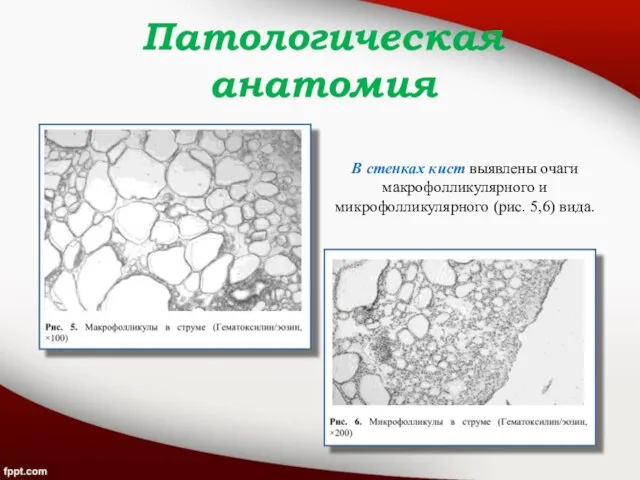 В стенках кист выявлены очаги макрофолликулярного и микрофолликулярного (рис. 5,6) вида. Патологическая анатомия