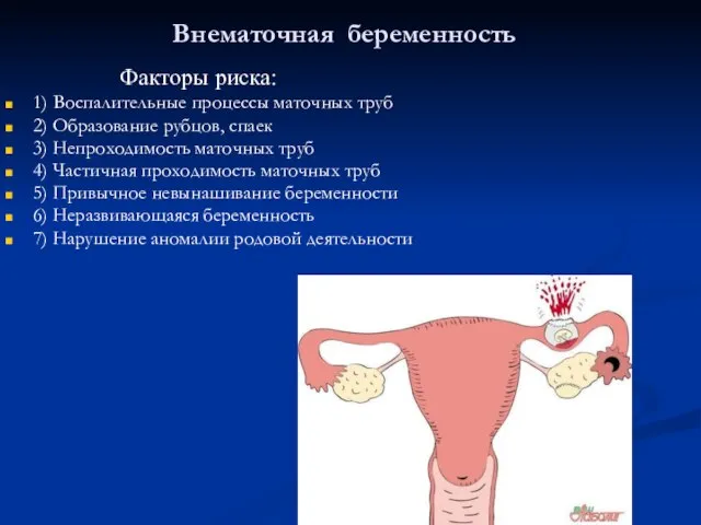 Внематочная беременность Факторы риска: 1) Воспалительные процессы маточных труб 2) Образование рубцов,