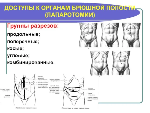 ДОСТУПЫ К ОРГАНАМ БРЮШНОЙ ПОЛОСТИ (ЛАПАРОТОМИИ) Группы разрезов: продольные; поперечные; косые; угловые; комбинированные.