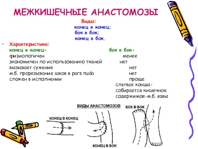 МЕЖКИШЕЧНЫЕ АНАСТОМОЗЫ Виды: конец в конец; бок в бок; конец в бок.