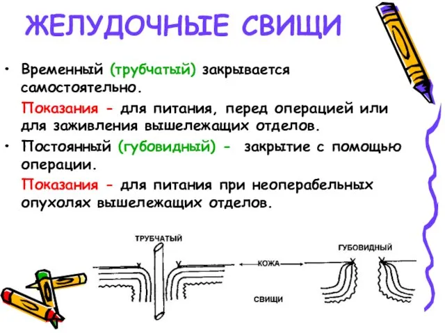 ЖЕЛУДОЧНЫЕ СВИЩИ Временный (трубчатый) закрывается самостоятельно. Показания - для питания, перед операцией