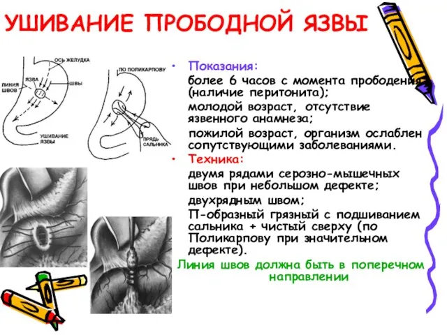 УШИВАНИЕ ПРОБОДНОЙ ЯЗВЫ Показания: более 6 часов с момента прободения (наличие перитонита);