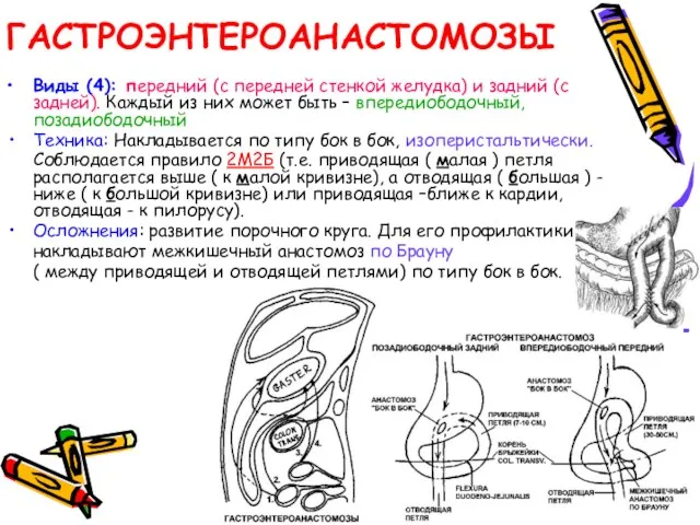 ГАСТРОЭНТЕРОАНАСТОМОЗЫ Виды (4): передний (с передней стенкой желудка) и задний (с задней).