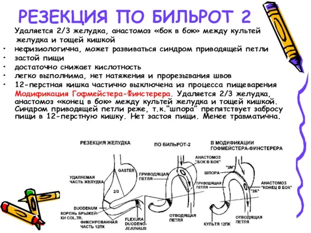 РЕЗЕКЦИЯ ПО БИЛЬРОТ 2 Удаляется 2/3 желудка, анастомоз «бок в бок» между