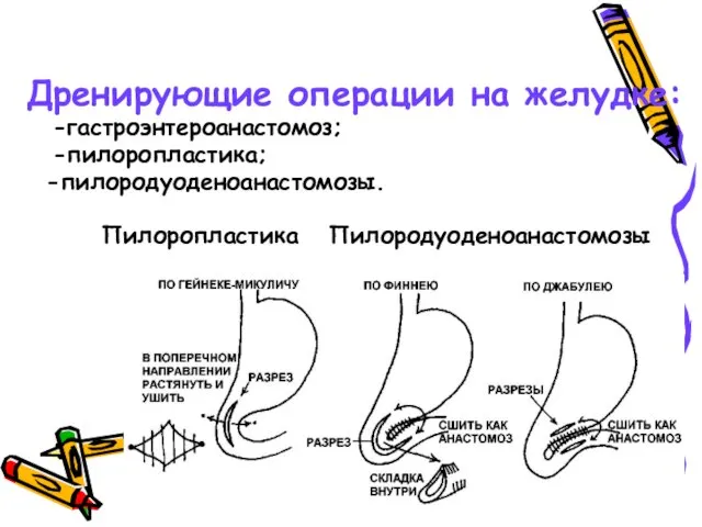 Дренирующие операции на желудке: -гастроэнтероанастомоз; -пилоропластика; -пилородуоденоанастомозы. Пилоропластика Пилородуоденоанастомозы