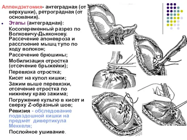 Аппендэктомия- антеградная (от верхушки), ретроградная (от основания). Этапы (антеградная): Косопеременный разрез по