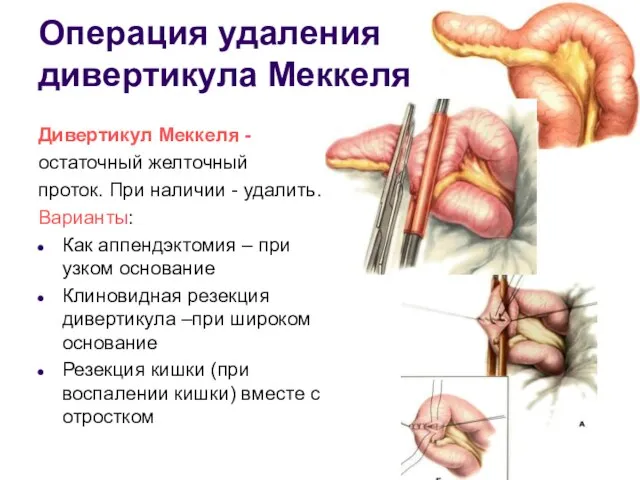 Операция удаления дивертикула Меккеля Дивертикул Меккеля - остаточный желточный проток. При наличии