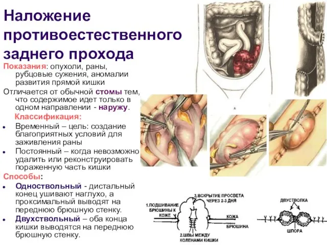 Наложение противоестественного заднего прохода Показания: опухоли, раны, рубцовые сужения, аномалии развития прямой