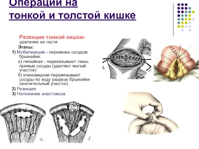 Операции на тонкой и толстой кишке Резекция тонкой кишки- удаление ее части