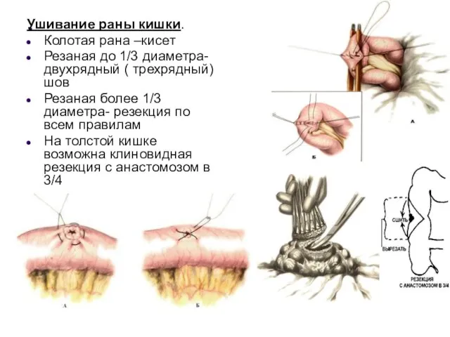 . Ушивание раны кишки. Колотая рана –кисет Резаная до 1/3 диаметра- двухрядный