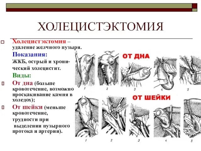 ХОЛЕЦИСТЭКТОМИЯ Холецистэктомия – удаление желчного пузыря. Показания: ЖКБ, острый и хрони- ческий