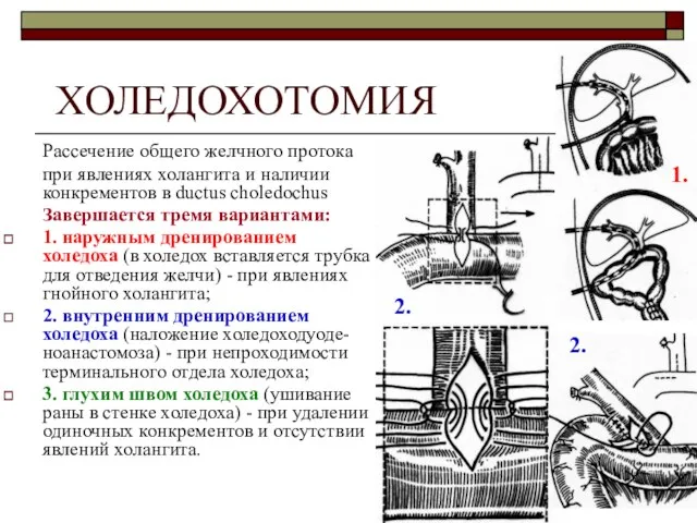 ХОЛЕДОХОТОМИЯ Рассечение общего желчного протока при явлениях холангита и наличии конкрементов в