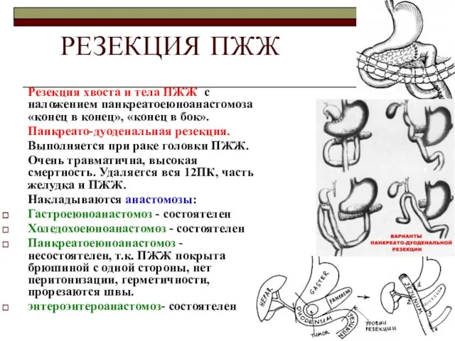 РЕЗЕКЦИЯ ПЖЖ Резекция хвоста и тела ПЖЖ с наложением панкреатоеюноанастомоза «конец в