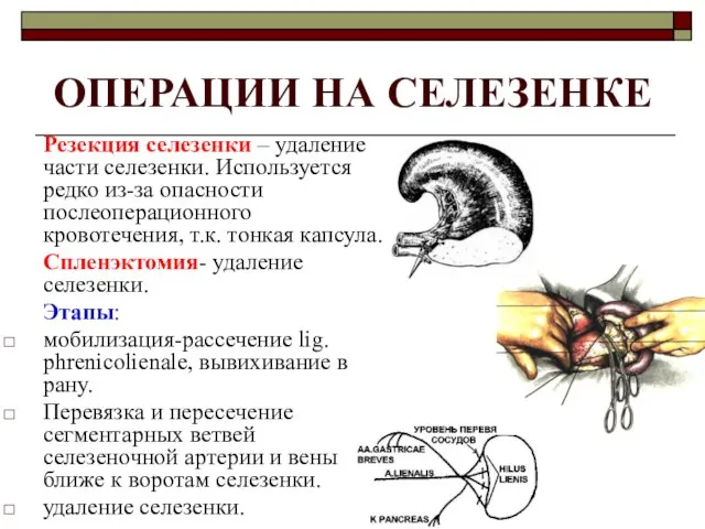 ОПЕРАЦИИ НА СЕЛЕЗЕНКЕ Резекция селезенки – удаление части селезенки. Используется редко из-за