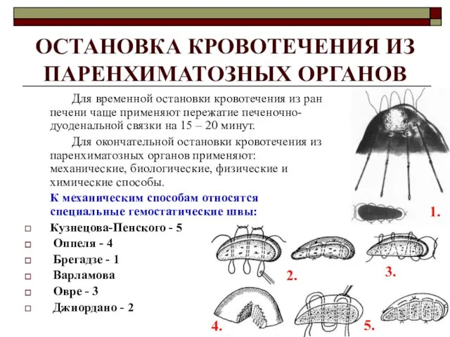 ОСТАНОВКА КРОВОТЕЧЕНИЯ ИЗ ПАРЕНХИМАТОЗНЫХ ОРГАНОВ Для временной остановки кровотечения из ран печени