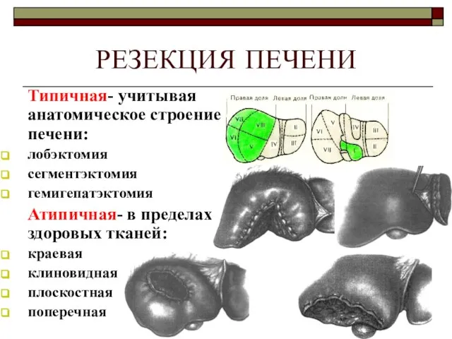 РЕЗЕКЦИЯ ПЕЧЕНИ Типичная- учитывая анатомическое строение печени: лобэктомия сегментэктомия гемигепатэктомия Атипичная- в