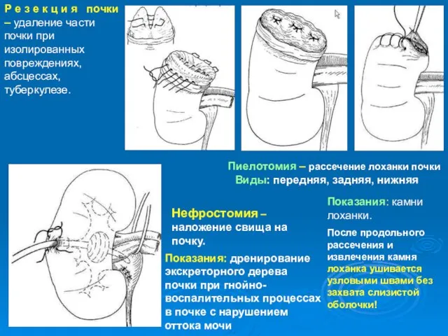 Р е з е к ц и я почки – удаление части