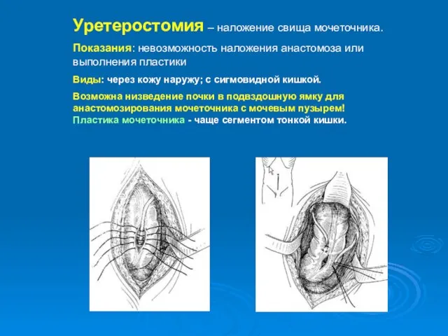 Уретеростомия – наложение свища мочеточника. Показания: невозможность наложения анастомоза или выполнения пластики