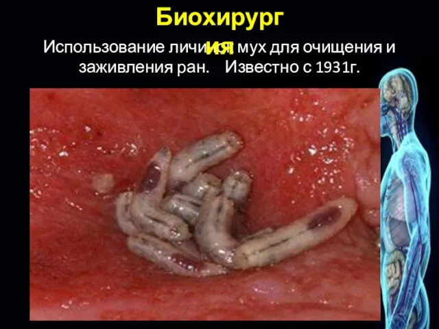 Использование личинок мух для очищения и заживления ран. Известно с 1931г. Биохирургия