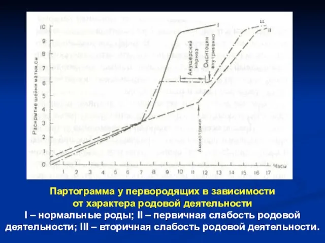 Партограмма у первородящих в зависимости от характера родовой деятельности I – нормальные