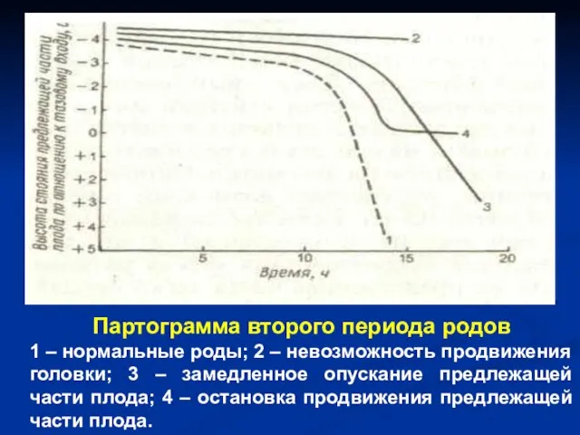 Партограмма второго периода родов 1 – нормальные роды; 2 – невозможность продвижения