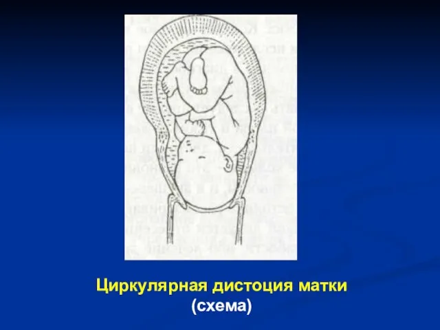 Циркулярная дистоция матки (схема)