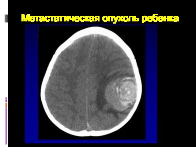 Метастатическая опухоль ребенка