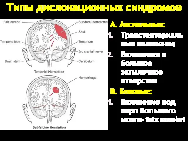 Типы дислокационных синдромов A. Аксиальные: Транстенториальные вклинения Вклинения в большое затылочное отверстие