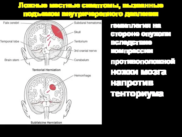 Ложные местные симптомы, вызванные подъемом внутричерепного давления гемиплегия на стороне опухоли вследствие