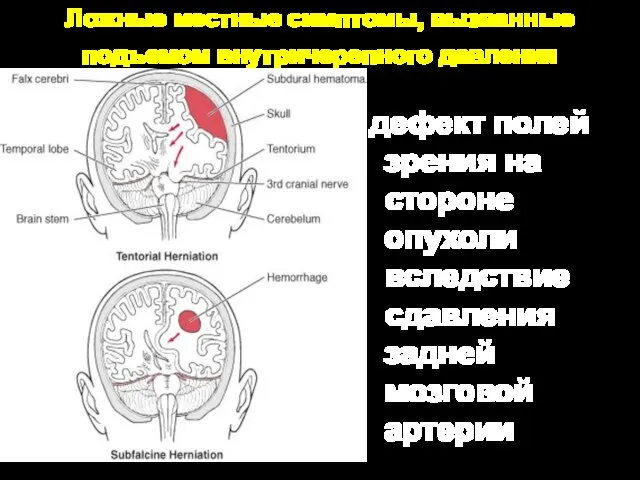 Ложные местные симптомы, вызванные подъемом внутричерепного давления дефект полей зрения на стороне