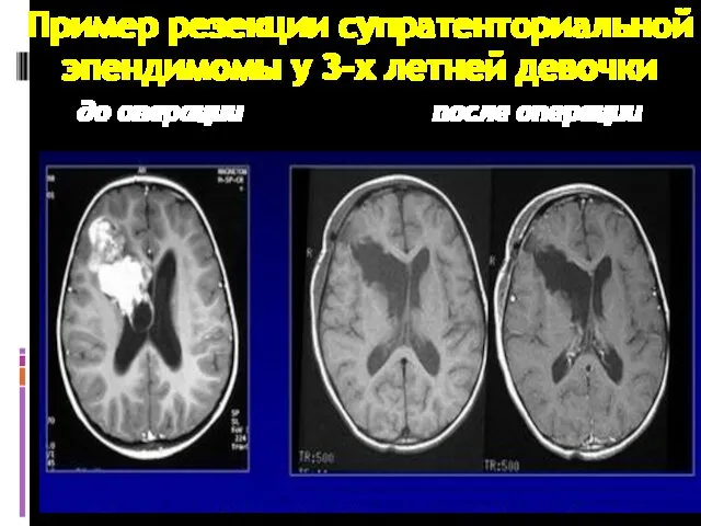 Пример резекции супратенториальной эпендимомы у 3-х летней девочки до операции после операции