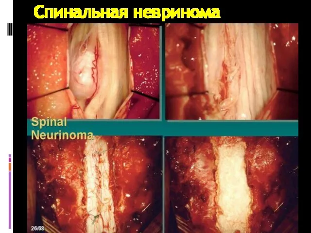 Спинальная невринома