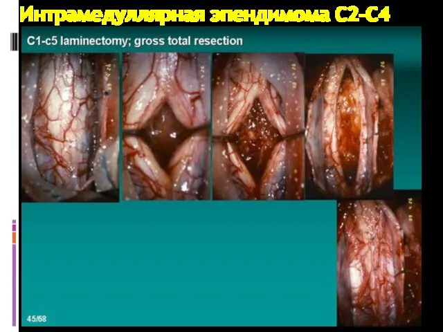 Интрамедуллярная эпендимома С2-С4