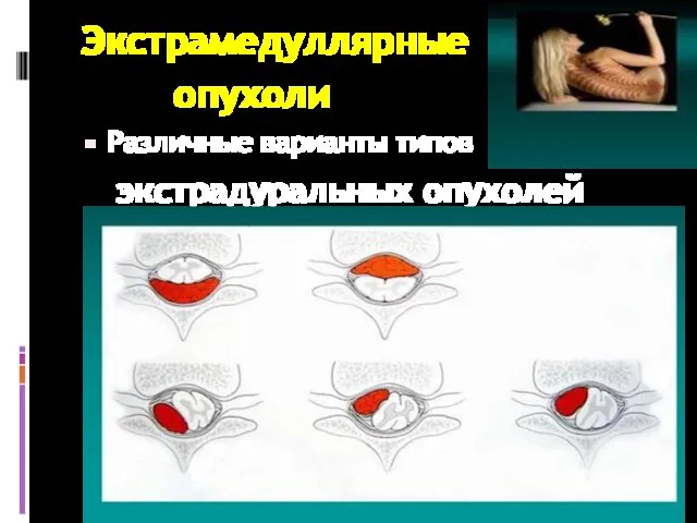 Экстрамедуллярные опухоли Различные варианты типов экстрадуральных опухолей