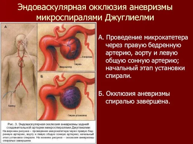 Эндоваскулярная окклюзия аневризмы микроспиралями Джуглиелми А. Проведение микрокатетера через правую бедренную артерию,