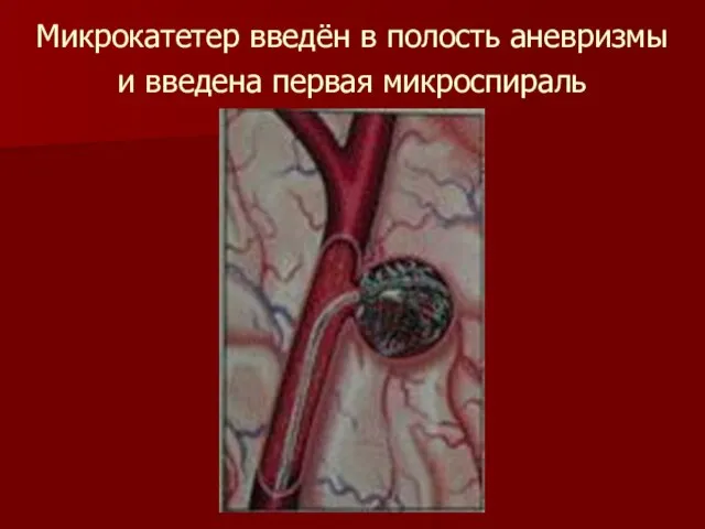 Микрокатетер введён в полость аневризмы и введена первая микроспираль