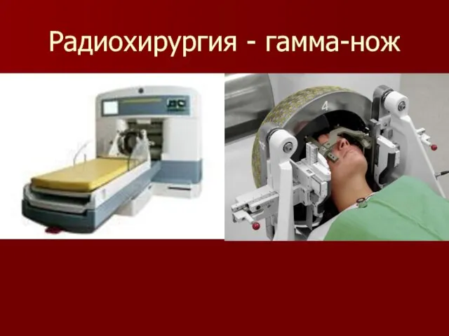 Радиохирургия - гамма-нож