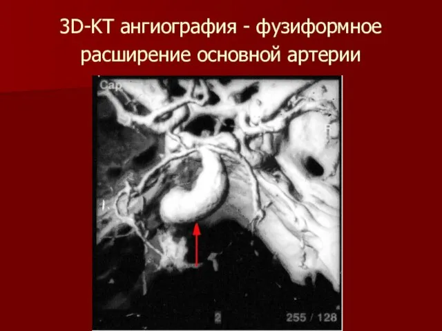 3D-KT ангиография - фузиформное расширение основной артерии