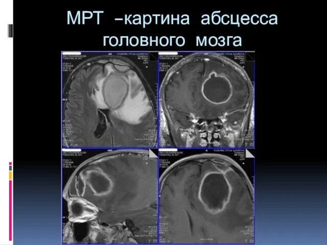 МРТ –картина абсцесса головного мозга