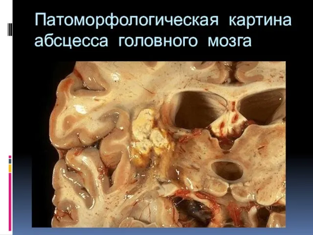 Патоморфологическая картина абсцесса головного мозга
