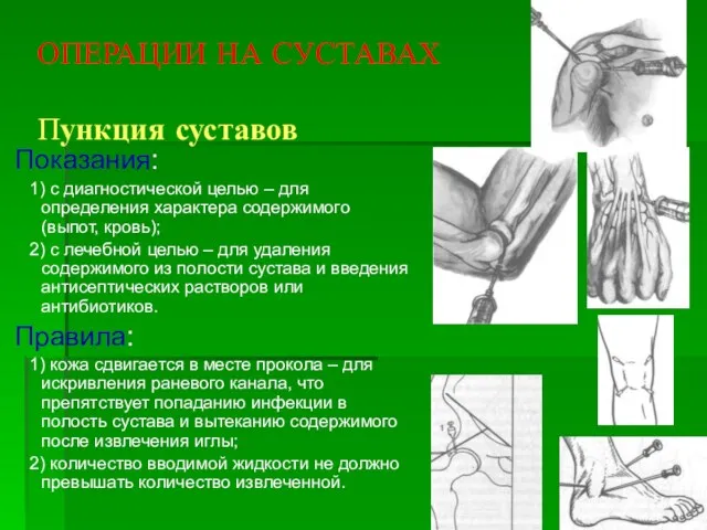 ОПЕРАЦИИ НА СУСТАВАХ Пункция суставов Показания: 1) с диагностической целью – для