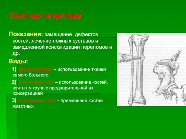 Костная пластика Показания: замещение дефектов костей, лечение ложных суставов и замедленной консолидации