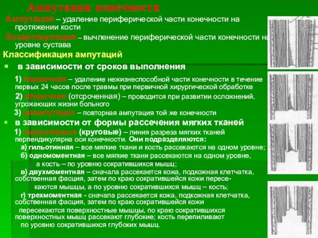 Ампутации конечности Ампутация – удаление периферической части конечности на протяжении кости Экзартикуляция