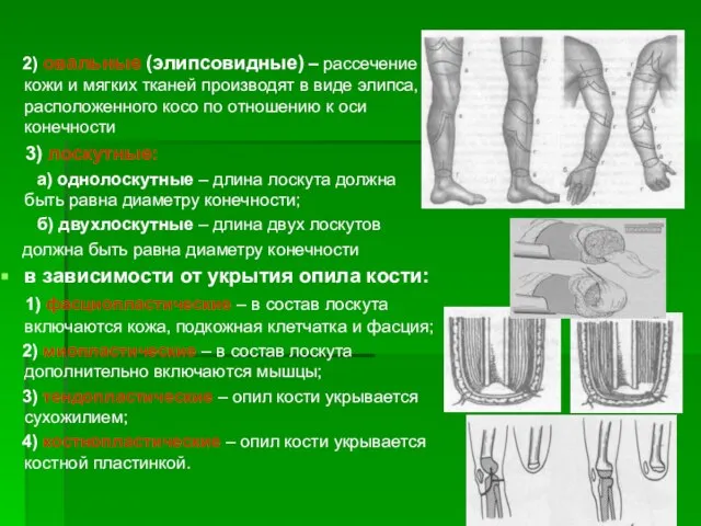 2) овальные (элипсовидные) – рассечение кожи и мягких тканей производят в виде